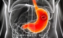 肾癌晚期能活多久,肾癌晚期生存时间与影响因素概述